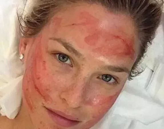 Bar Refaeli faz tratamento com injeção de sangue no rosto