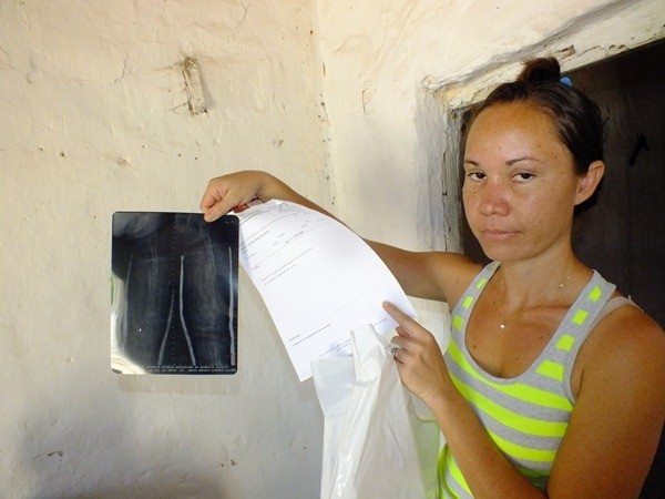 Criança tem ossos de Vidro no interior do Piaui  - Imagem 6