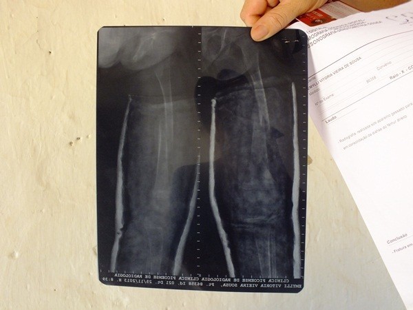 Criança tem ossos de Vidro no interior do Piaui  - Imagem 8