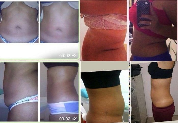 A Fisioterapeuta barrense Rinara Silva estará em Barras com o método Criolipólise. Veja! - Imagem 2