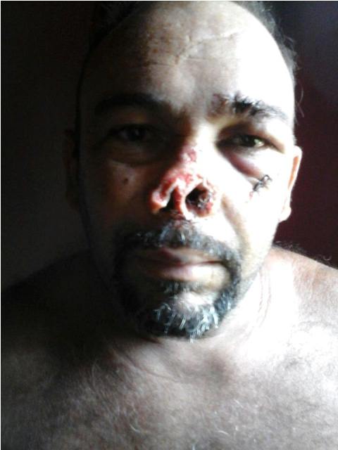 Homem é atingido com golpe de facão e tem parte do nariz decepado - Imagem 1