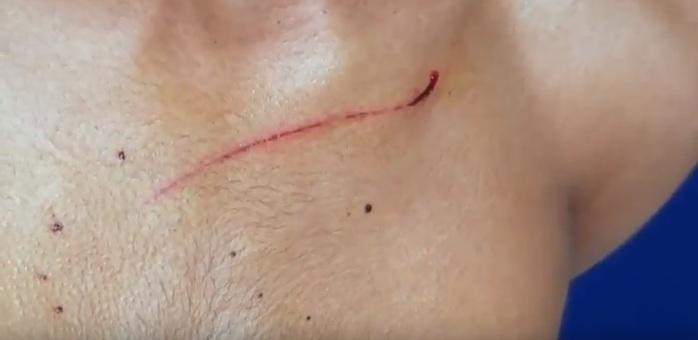 Menor sofreu um pequeno corte no peito.  (Crédito: Kairo Amaral)