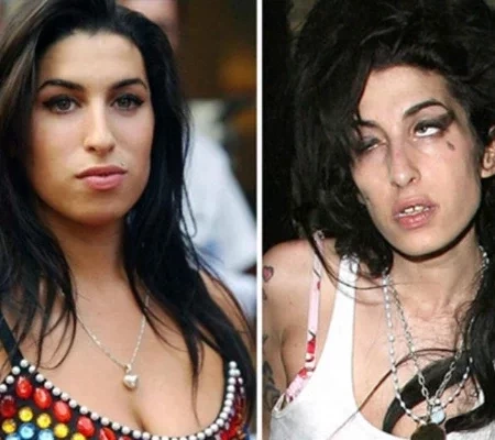 Confira fotos das  celebridades antes e depois de usarem drogas