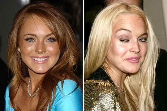 Confira fotos das  celebridades antes e depois de usarem drogas - imagem 11539