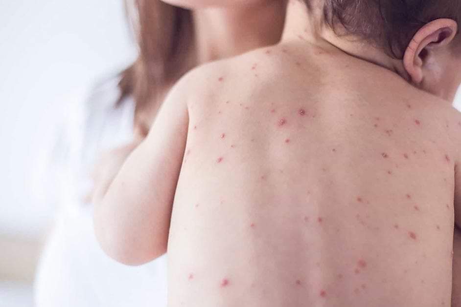 Prefeito João Luiz entra em campo no combate ao Sarampo  - Imagem 3