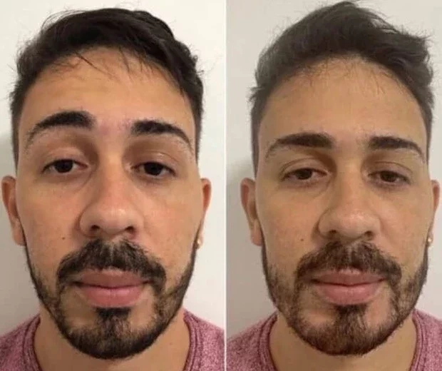 Confira o antes e depois de famosos que fizeram harmonização facial - imagem 13379