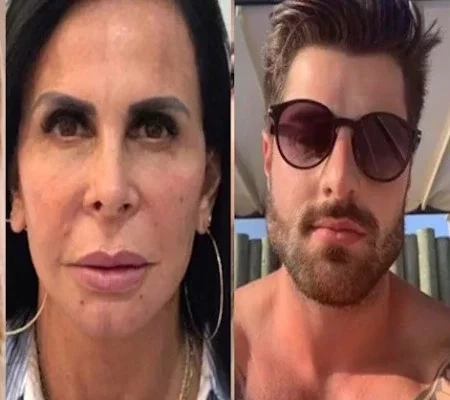 Confira o antes e depois de famosos que fizeram harmonização facial