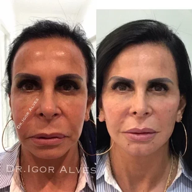 Confira o antes e depois de famosos que fizeram harmonização facial - imagem 13369