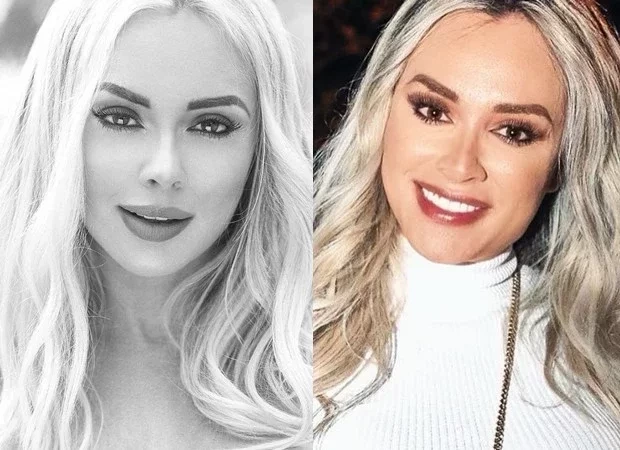 Confira o antes e depois de famosos que fizeram harmonização facial - imagem 13377