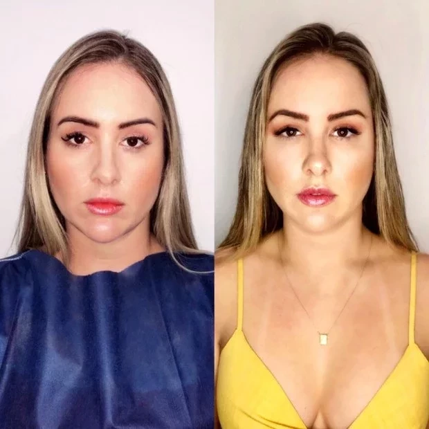 Confira o antes e depois de famosos que fizeram harmonização facial - imagem 13375