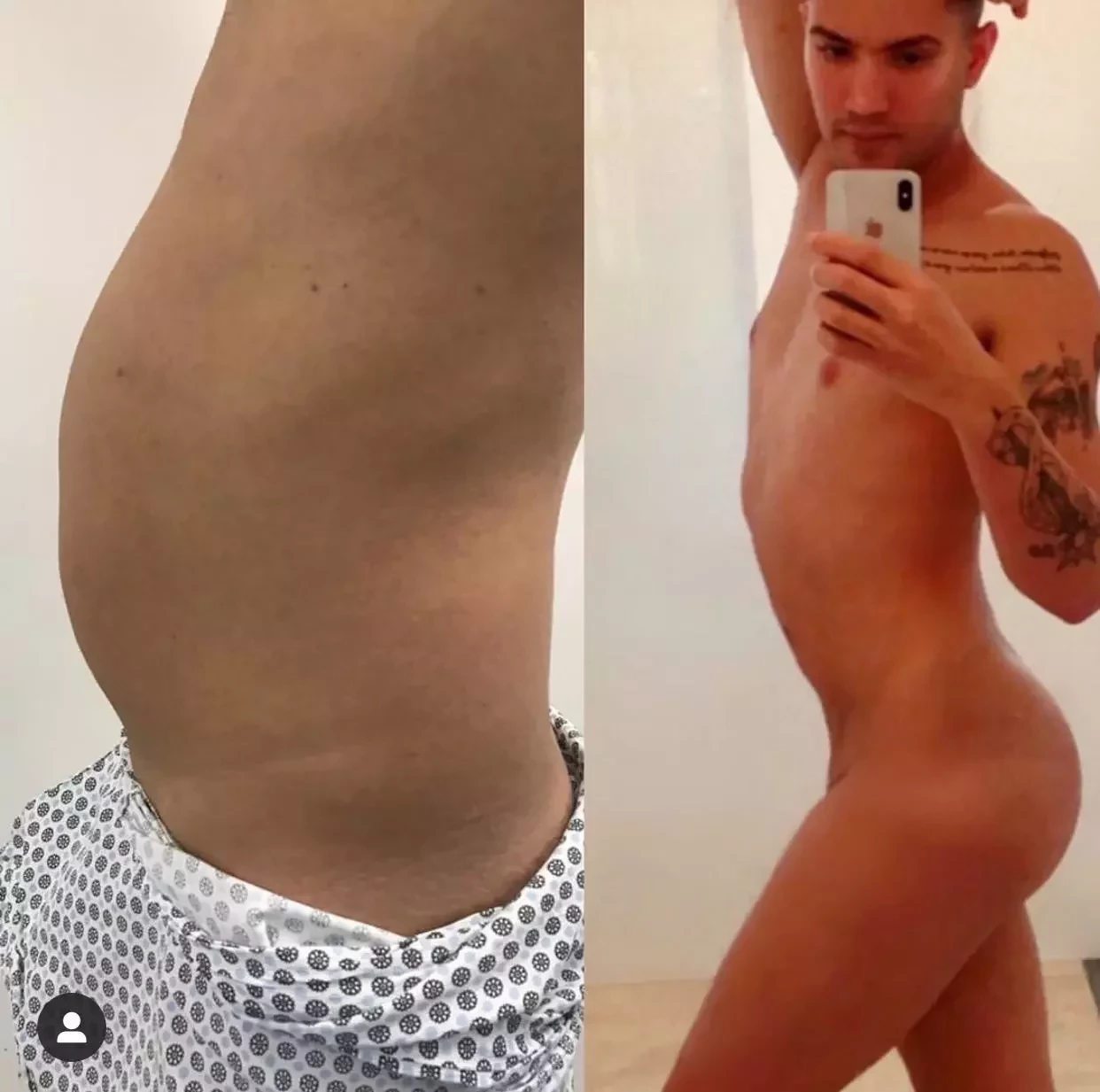 Aretuza Lovi exibe antes e depois de lipo e cirurgia no bumbum; fotos - imagem 28004