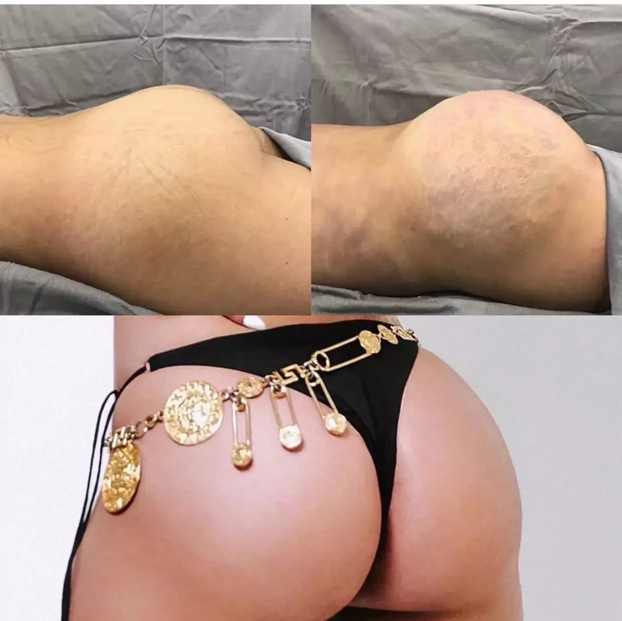 Aretuza Lovi exibe antes e depois de lipo e cirurgia no bumbum; fotos - imagem 28005