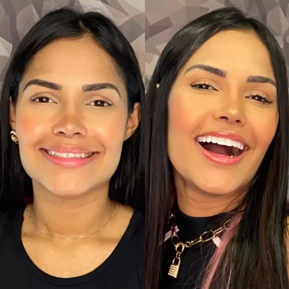 Veja os famosos que apostaram na lente de contato dental - imagem 30542