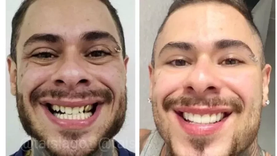Veja os famosos que apostaram na lente de contato dental - imagem 30538