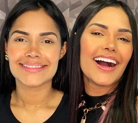 Veja os famosos que apostaram na lente de contato dental
