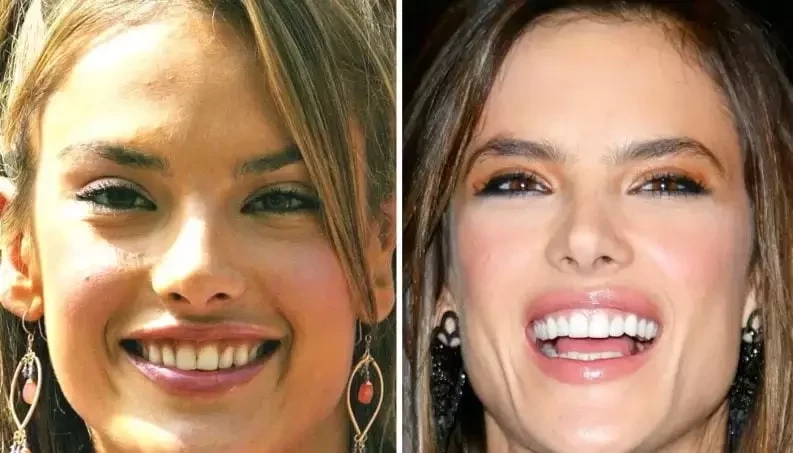 Confira antes e depois dos sorrisos das celebridades após a fama - imagem 15783