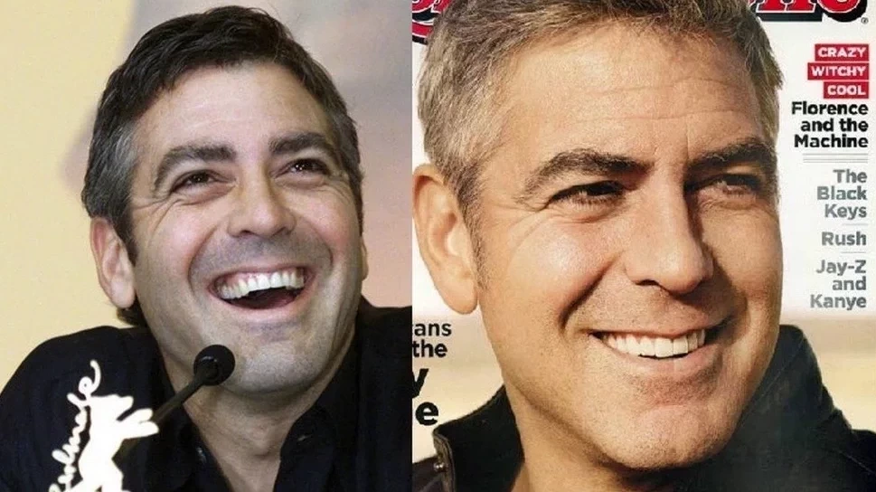 Confira antes e depois dos sorrisos das celebridades após a fama - imagem 15776
