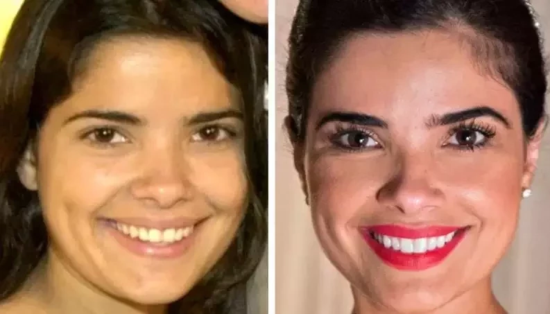 Confira antes e depois dos sorrisos das celebridades após a fama - imagem 15784