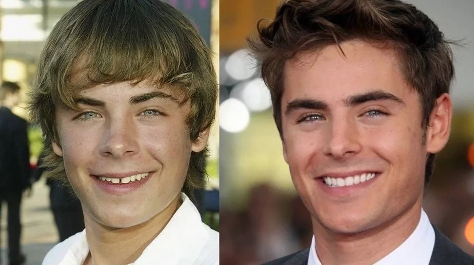 Confira antes e depois dos sorrisos das celebridades após a fama - imagem 15775