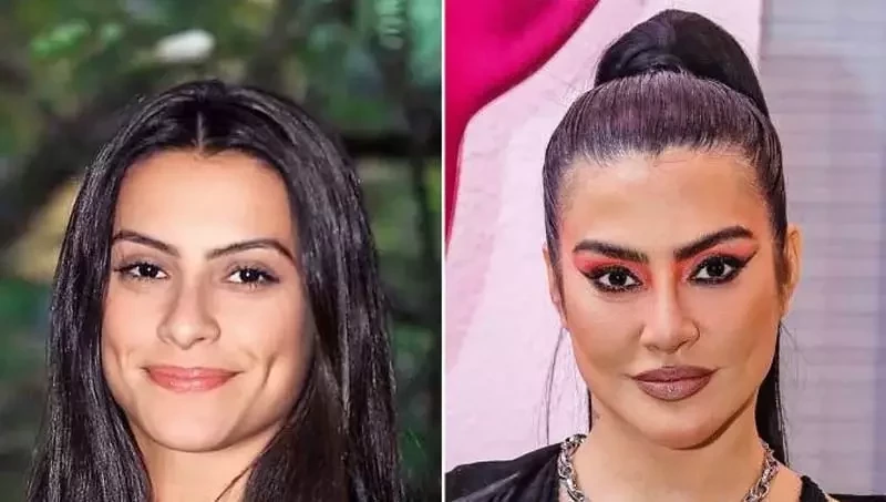 Veja o antes e depois das famosas que fizeram harmonização facial - imagem 20332