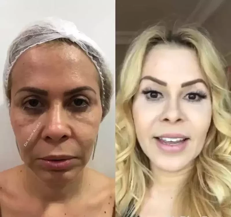 Veja o antes e depois das famosas que fizeram harmonização facial - imagem 20335