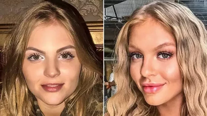 Veja o antes e depois das famosas que fizeram harmonização facial - imagem 20341