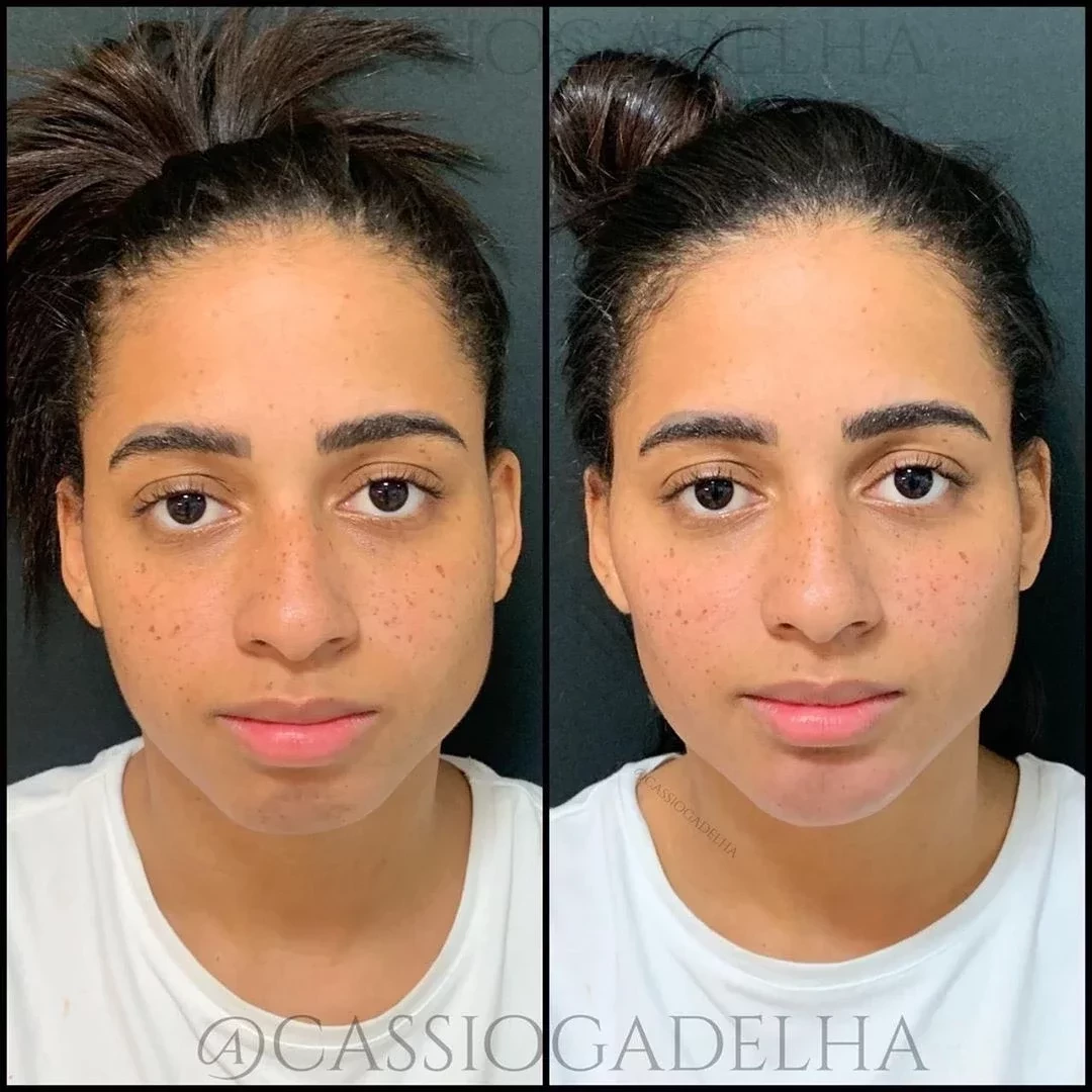 Veja o antes e depois das famosas que fizeram harmonização facial - imagem 20339