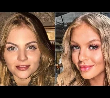 Veja o antes e depois das famosas que fizeram harmonização facial
