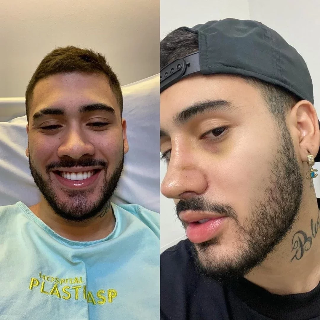 Famosos aproveitam a quarentena para fazer plásticas; veja fotos - imagem 22290