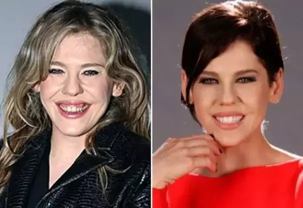 Diga xis! Confira o antes e depois do sorriso das celebridades  - imagem 21409