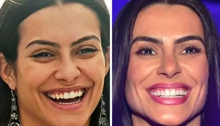 Diga xis! Confira o antes e depois do sorriso das celebridades  - imagem 21402