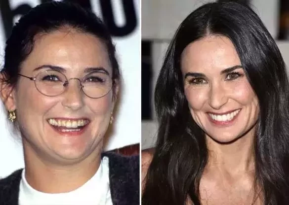 Diga xis! Confira o antes e depois do sorriso das celebridades  - imagem 21398