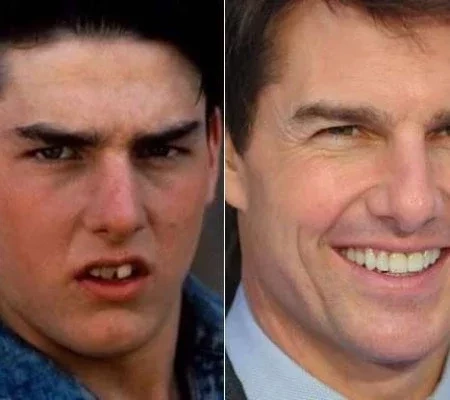 Diga xis! Confira o antes e depois do sorriso das celebridades 