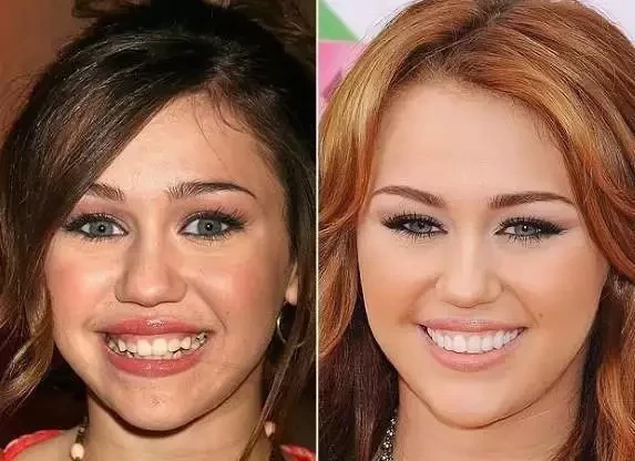 Diga xis! Confira o antes e depois do sorriso das celebridades  - imagem 21401