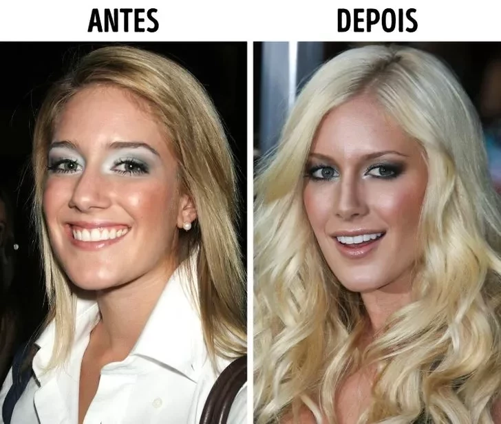 Confira o Antes e Depois das cirurgias plásticas de 15 famosas - imagem 22856