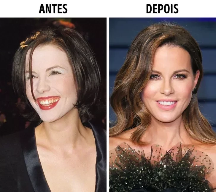 Confira o Antes e Depois das cirurgias plásticas de 15 famosas - imagem 22850