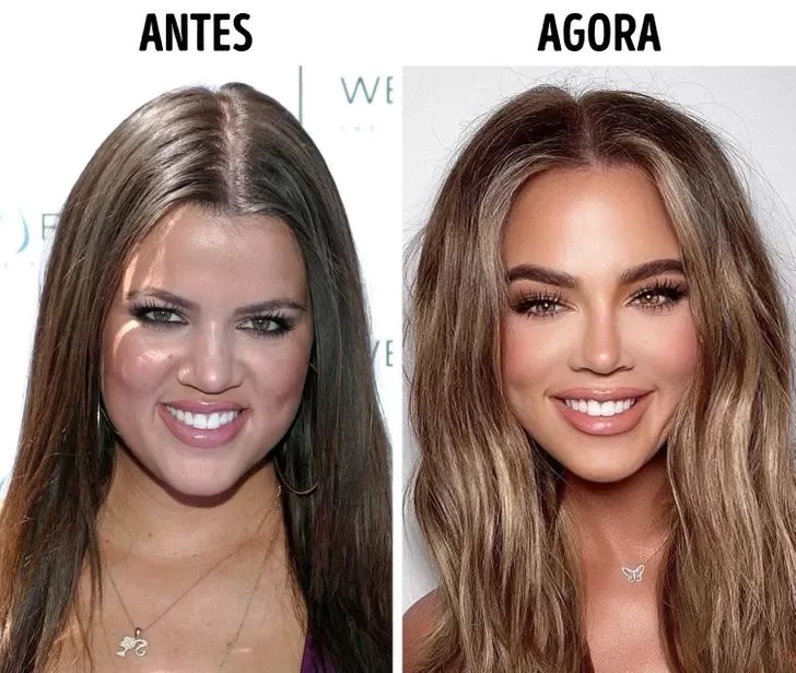 Confira o Antes e Depois das cirurgias plásticas de 15 famosas - imagem 22847