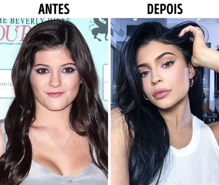 Confira o Antes e Depois das cirurgias plásticas de 15 famosas - imagem 22860