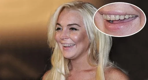 De separados a tortos! Conheça as celebridades com os dentes ruins - imagem 25484