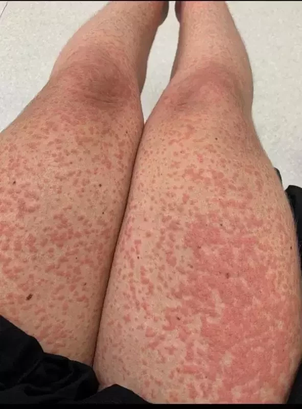 Veja fotos chocantes de Tati Minerato após lipo que quase a matou - imagem 25737