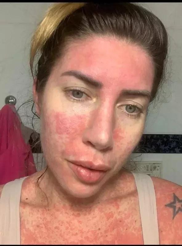 Veja fotos chocantes de Tati Minerato após lipo que quase a matou - imagem 25736