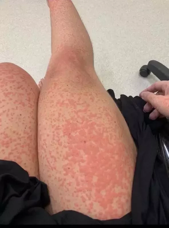 Veja fotos chocantes de Tati Minerato após lipo que quase a matou - imagem 25738