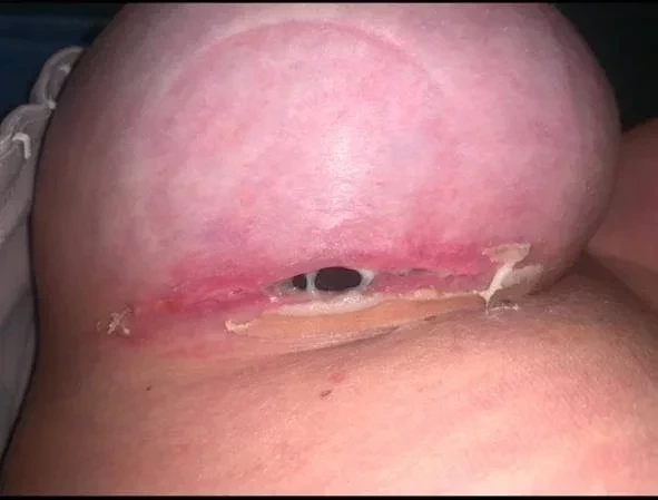 Veja fotos chocantes de Tati Minerato após lipo que quase a matou - imagem 25735