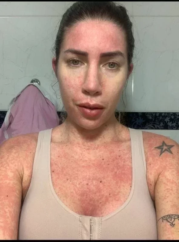 Veja fotos chocantes de Tati Minerato após lipo que quase a matou - imagem 25733
