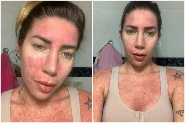 Veja fotos chocantes de Tati Minerato após lipo que quase a matou - imagem 25732