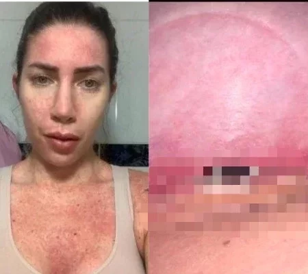 Veja fotos chocantes de Tati Minerato após lipo que quase a matou