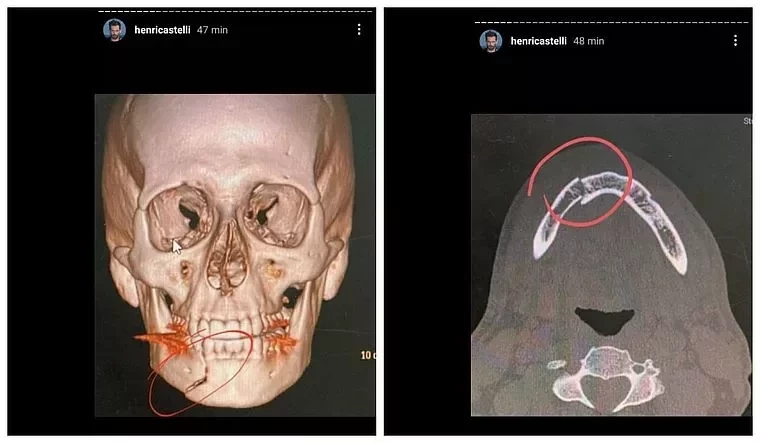 Henri Castelli precisará de tratamentos e reabilitação, diz cirurgiã - imagem 31823