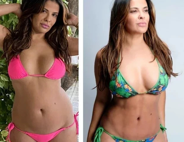Gyselle Soares antes e depois da cirurgia plástica | FOTO: Divulgação