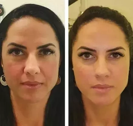 Antes e depois: veja como estes famosos ficaram após a harmonização facial - imagem 63658