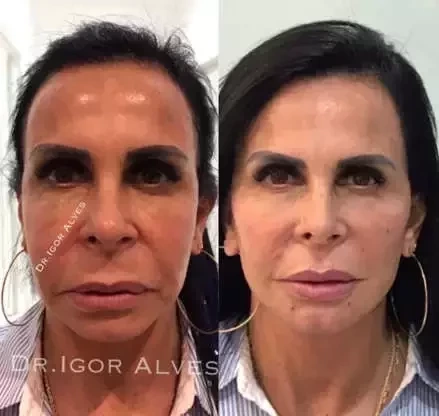 Antes e depois: veja como estes famosos ficaram após a harmonização facial - imagem 63652